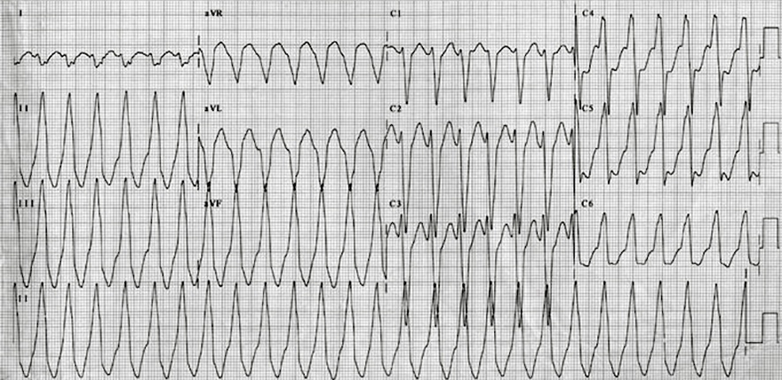 ECG Right Ventricular Outflow Tract (RVOT) Tachycardia, precordial transition R/S  V4, inferior axis, LBBB-like morphology 