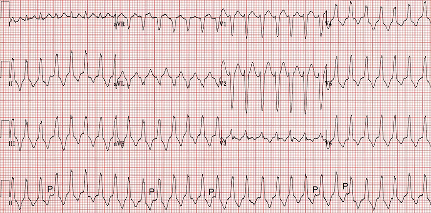 ECG Right ventricular outflow tract (RVOT) ventricular tachycardia, precordial transition, Inferior axis, AV dissociation