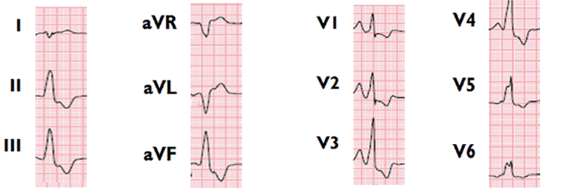 Premature ventricular complex (PVC), Left Ventricular Outflow Tract origin