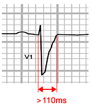 ECG broad widening QRS complexes 110ms in V1-3, ARVD