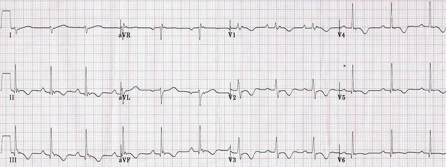ECG ARVC, epsilon wave, inversion T wave, prolonged S wave upstroke