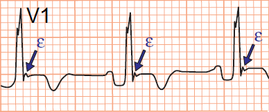Epsilon wave Arrhythmogenic Right Ventricular Dysplasia (ARVD)