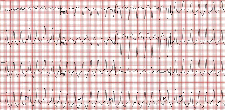 ECG wide complex tachycardia, AV dissociation, idiopatic VT vs. ventricular tachycardia RVOT with Arrhythmogenic Right Ventricular Dysplasia (Cardiomyopathy)