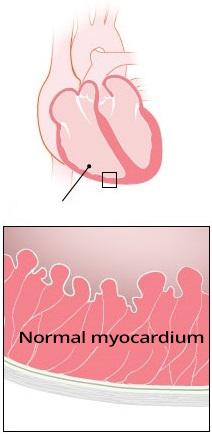 Idiopathic ventricular tachycardia, normal myocardium