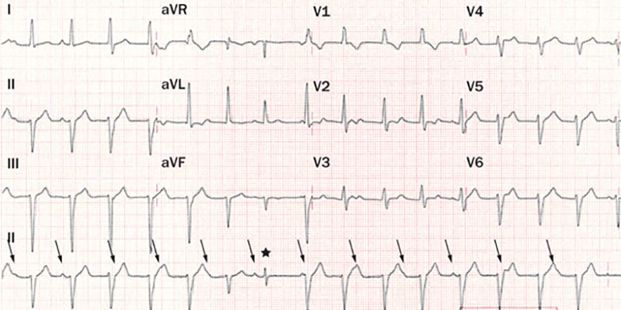 ECG Posterior fascicular VT, RBBB morphology, left axis deviation, AV dissociation, fusion beat, capture beat