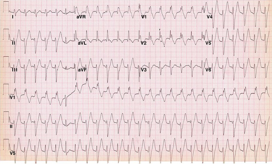 ECG left posterior fascicular tachycardia, verapamil-sensitive VT, infrafascicular tachycardia, RBBB morphology, left anterior hemiblock, av dissociation