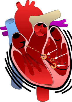 Fascicular ventricular tachycardia, Belhassen-type VT, verapamil-sensitive VT or infrafascicular tachycardia