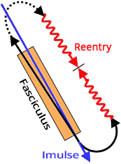 Sinus rhythm, fascicular reentry, fast - slow pathway