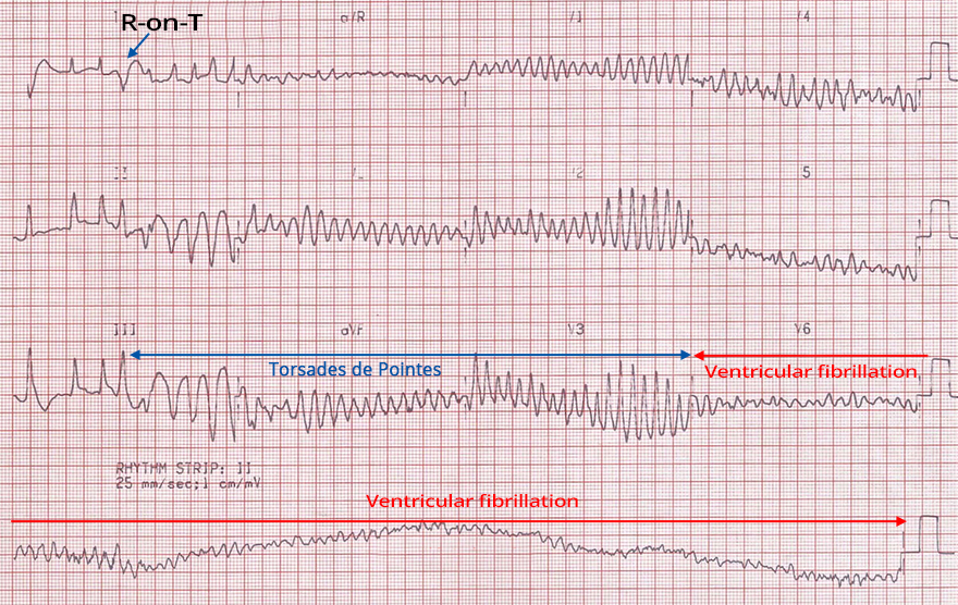 ECG phenomenon R on T, Torsades de Pointes, Fine ventricular fibrillation