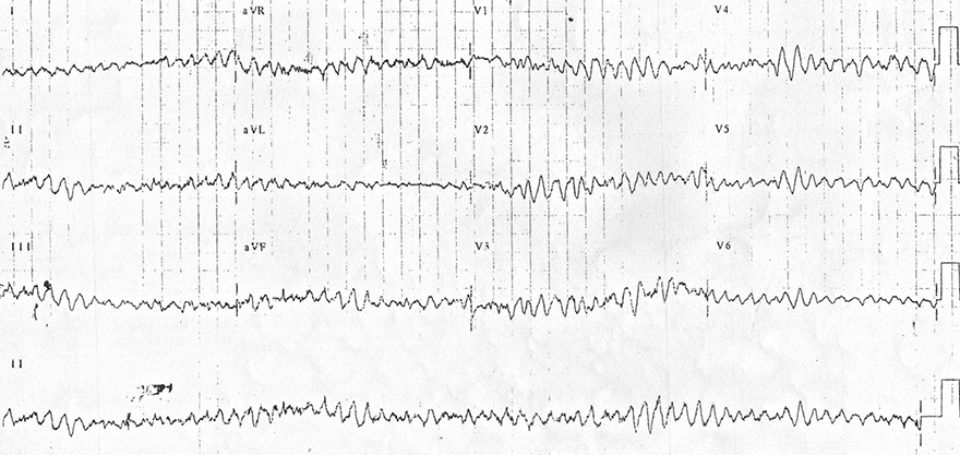 ECG fine ventricular fibrillation