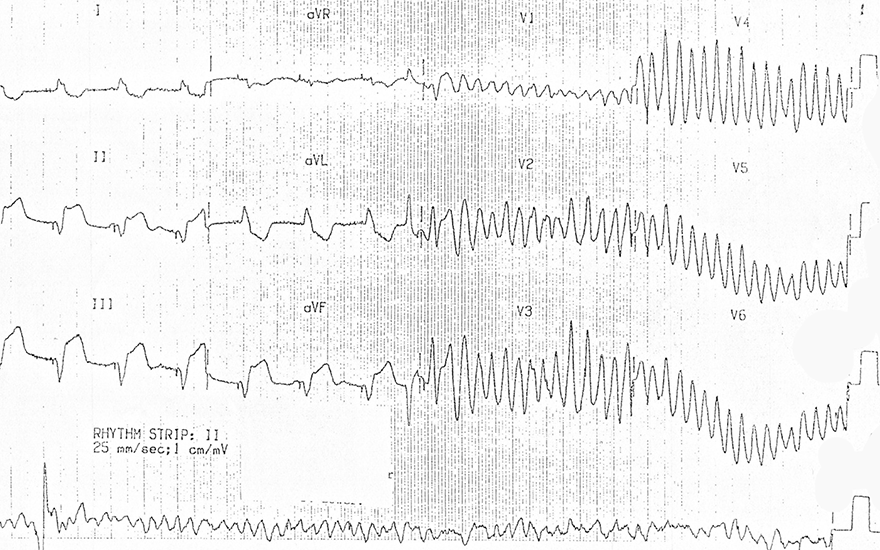 ECG pacemaker spikes, inferior STEMI infarction, Polymorphic ventricular tachycardia, Ventricular fibrillation