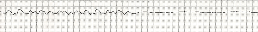 ECG fine ventricular fibrillation (VF, V-fib), asystole