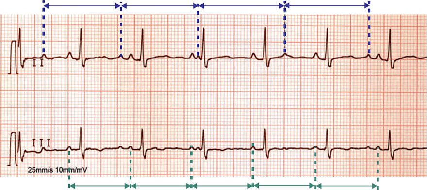 ECG atrial parasystole, heart transplantation, sinus rhythm, atrial ectopic rhythm