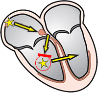 Ectopic ventricular focus, entrance block, exit block