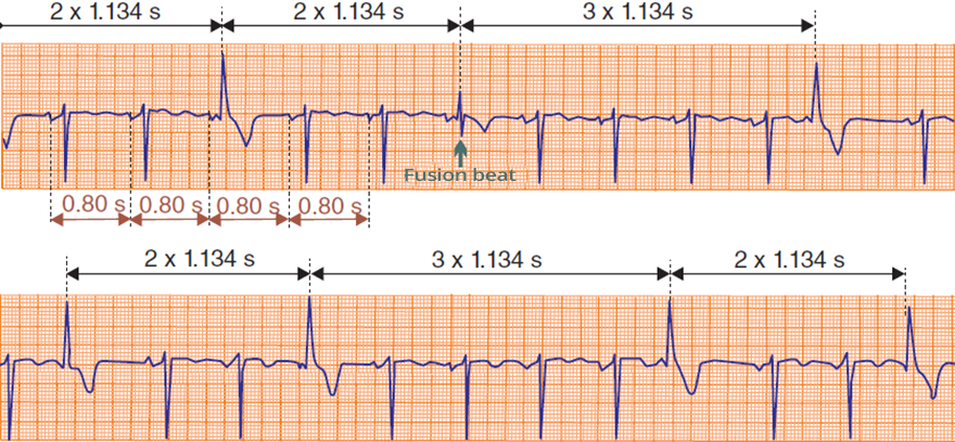 ECG parasystole, fusion beat, coupling intevals, sinus rhythm, ventricular extrasystoles