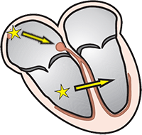 Ventricular extrasystole, coupling intervals