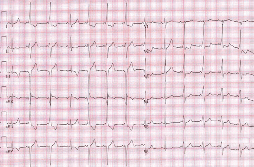 ECG intermittent WPW syndrome type B, sinus rhythm