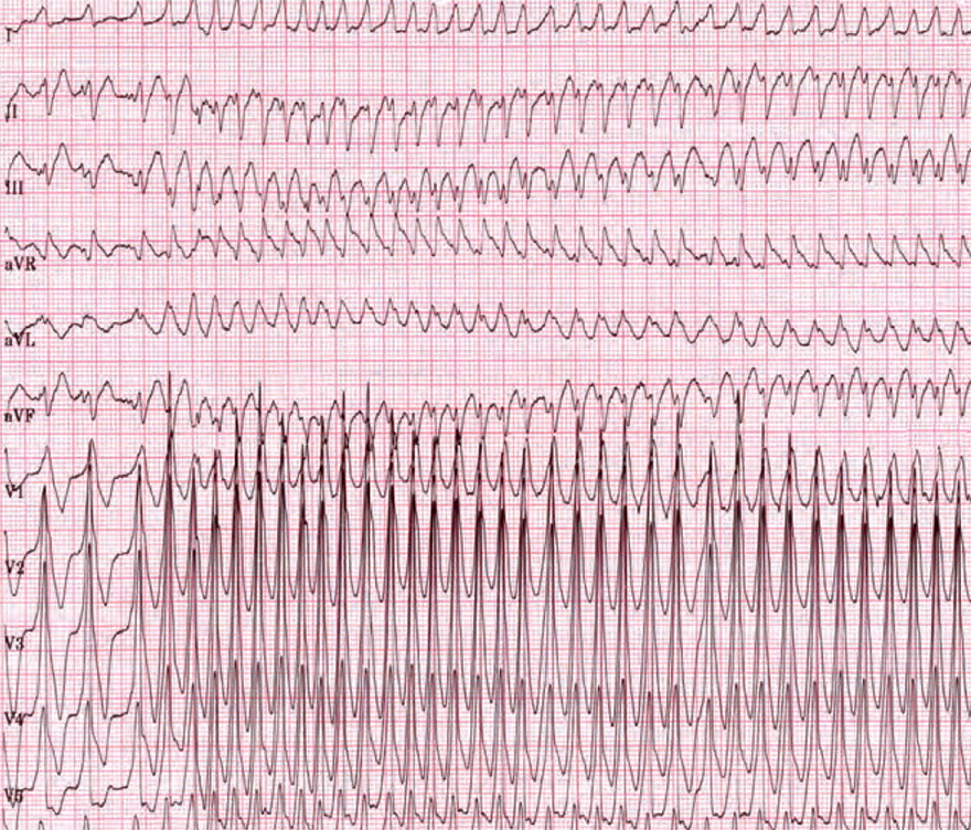 ECG wpw syndrome, ventricular fibrillation, and atrial fibrillation