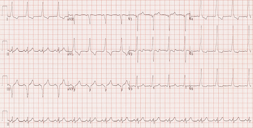 ECG wpw syndrome, type B, delta wave, Q wave, pseudo-infarction pattern