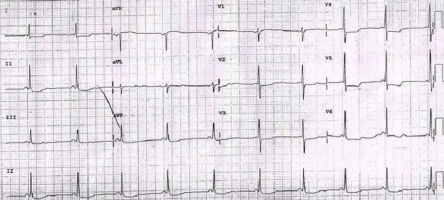 ECG LGL syndrome, short PR inteval, narrow QRS compelex