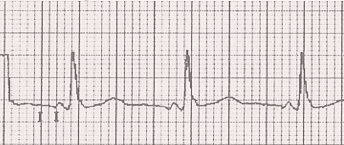 ECG Short PR interval, LGL syndrome, Enhanced atrioventricular nodal conduction