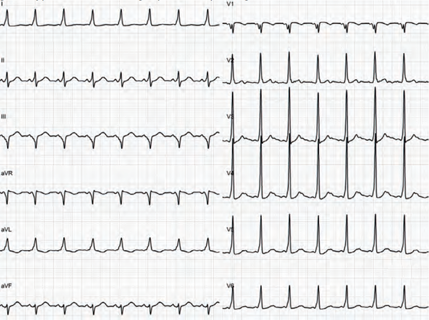 ECG wpw syndrome right postero septal accessory pathway anatomic location