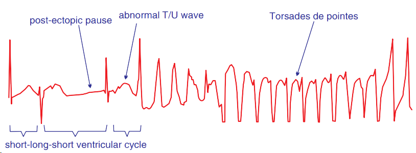 ECG short-long-shortsequence (SLS) pattern, Torsades de Pointes, phenomenon R on T, Torsades de Pointes (TdP)