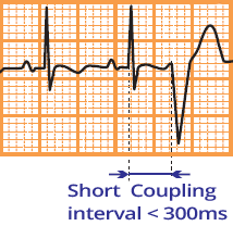 ECG short coupling interval 300ms