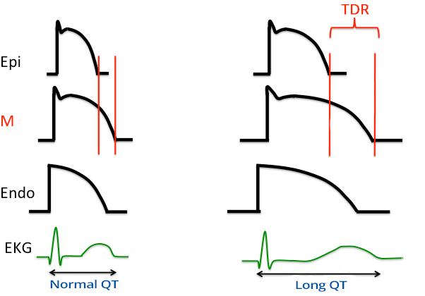 ECG prolonged QT interval, transmural dispersion repolarization, 