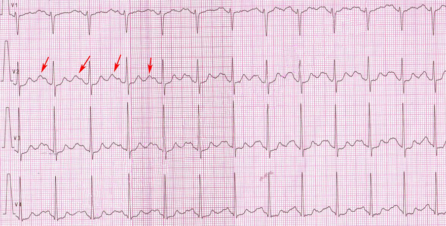 ECG sinus rhythm, U wave, Bidirectional ventricular tachycardia (BVT)