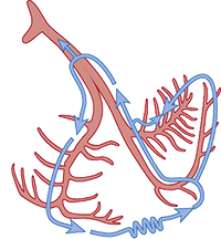 Bundle Branch Reentry Tachycardia Type A, anterograde retrograde conduction