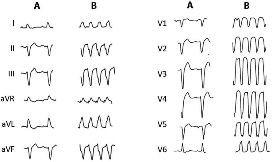 ECG Bundle branch reentry ventricular tachycardia, Type A