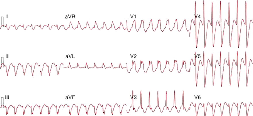 ECG Bundle branch reentrant ventricular tachycardia, Type B (BBRT Type B)