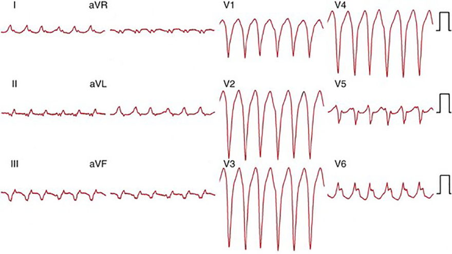 ECG Bundle branch reentrant ventricular tachycardia, Type A