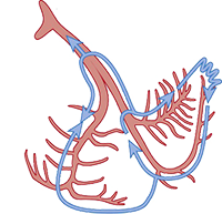 Interfascicular reentry ventricular tachycardia, anterior posterior fasciculus, anterograde retrograde conduction