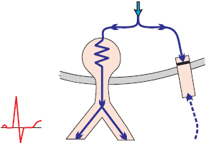 concealed accessory pathway, WPW syndrome, retrograde accessory pathway refractory block