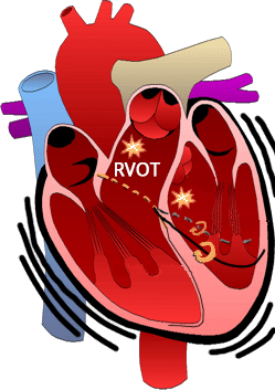 Right Ventricular Outflow Tract (RVOT) Tachycardia (Monomorphic VT)