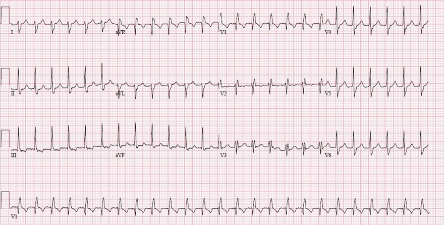 ECG Anterior fascicular VT, RBBB morphology, Right axis deviation, 
