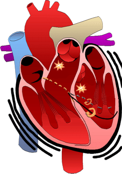 idiopathic monomorphic ventricular tachycardia, RVOT-VT, LVOT-VT, Fascicular VT