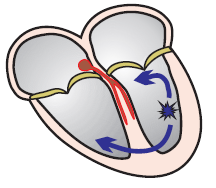 Ectopic focus, exit site, broad QRS complex, ventricular tachycardia