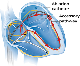 Radiofrequency Catheter Ablation of Supraventricular Tachycardia, AVRT, accessory pathway
