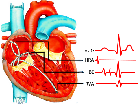 electrophysiology study (EPS) heart, Intracardiac electrograms, HRA = high right atrial electrogram,HBE = His bundle electrogram, A = low right atrial activity, H = His bundle activity, and V = ventricular septal activity, P–R, P–A, A–H, and H–V intervals, RVA - Right Ventricular Apex