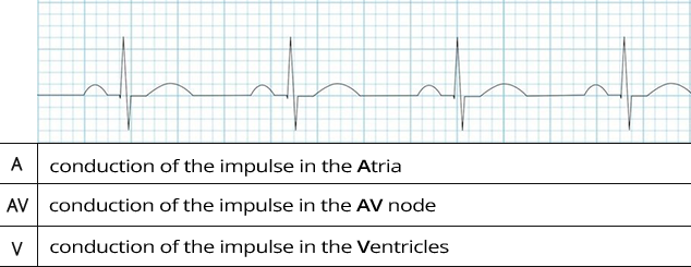 Laddergram, A - atria, AV - AV node, V - Ventricles