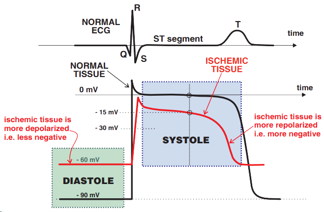 Diastole - ischemic tissue is more depolarized, Systole - ischemic tissue is more repolarized, Normal tissue vs. ischemic tissue