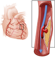 subendocardial ischemia, LAD stenosis