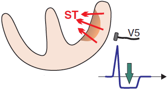 Acute coronary syndrome, ST depression, subendocardial ischemia