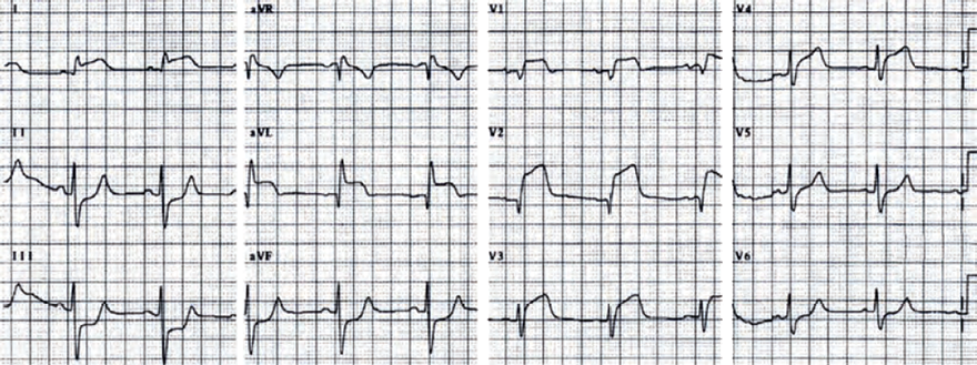 ECG acute coronary syndrome, acute anterior STEMI infarction