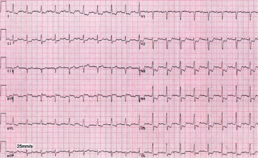 ECG post exercise ischemia, sinus tachycardia, ST depression, T wave inversion, ST elevation aVR