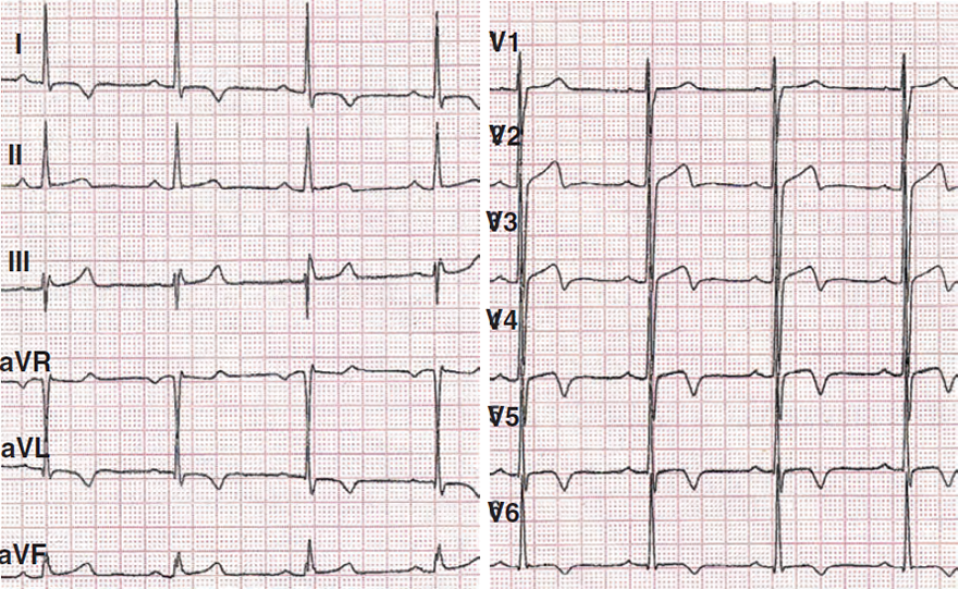 ECG ischemia, unstable angina pectoris, inversion T wave (I, aVL, V2-V6)