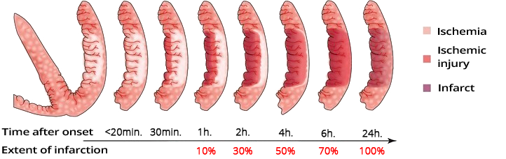 Coronary artery occlusion, dynamics ischemia duration, subendocardial ischemia, subepicardial ischemia, transmural ischemia, myocardial injury, myocardial infarction and necrosis